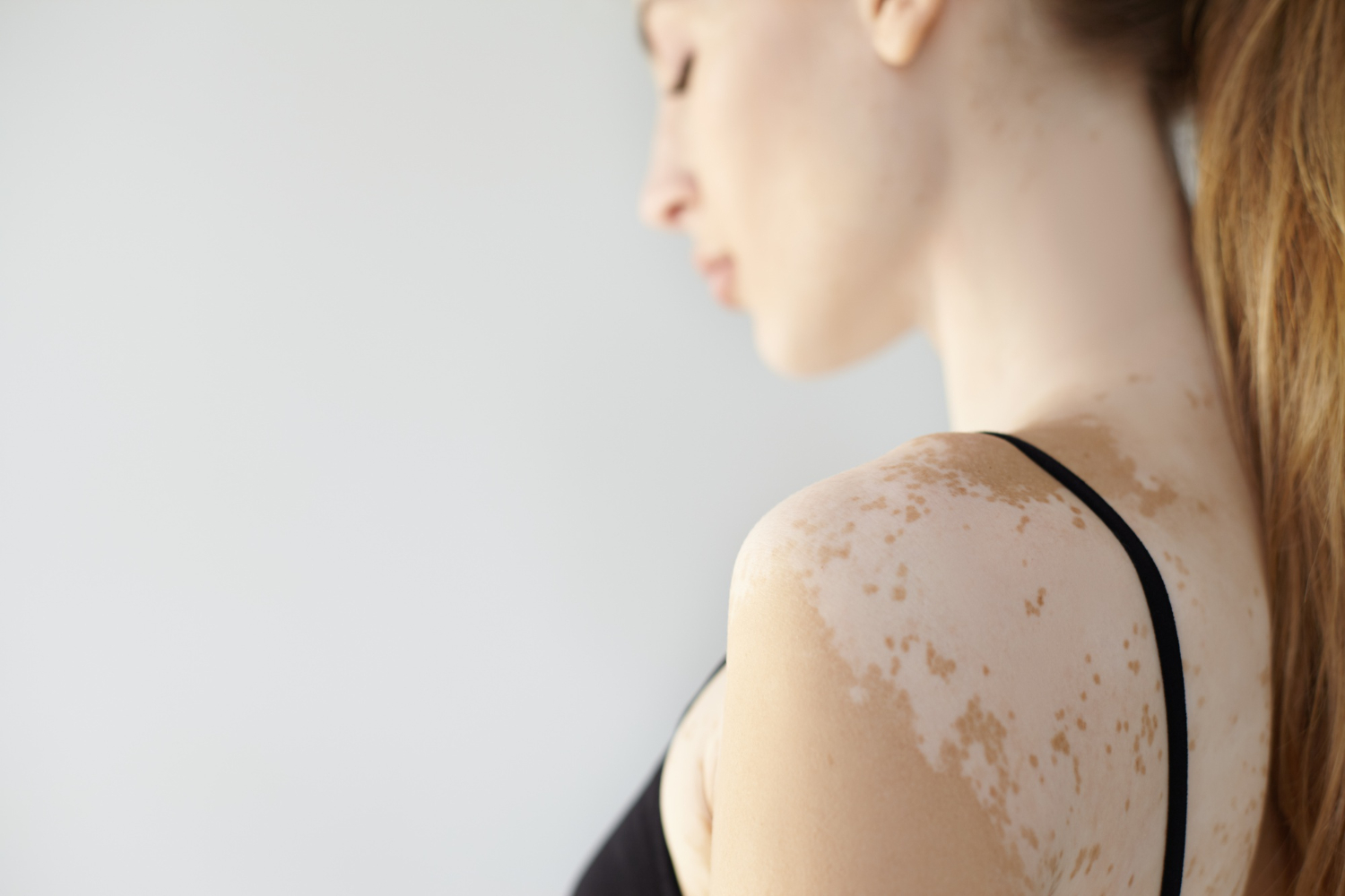 Fractional laser for skin resurfacing, pigmentation, acne scars, and fine lines