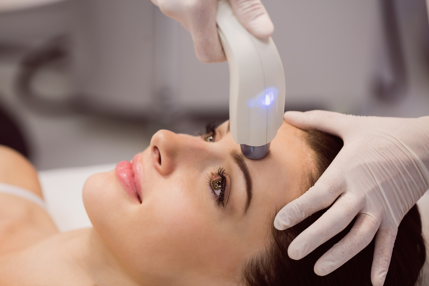 IPL photo rejuvenation for redness & pigmentation