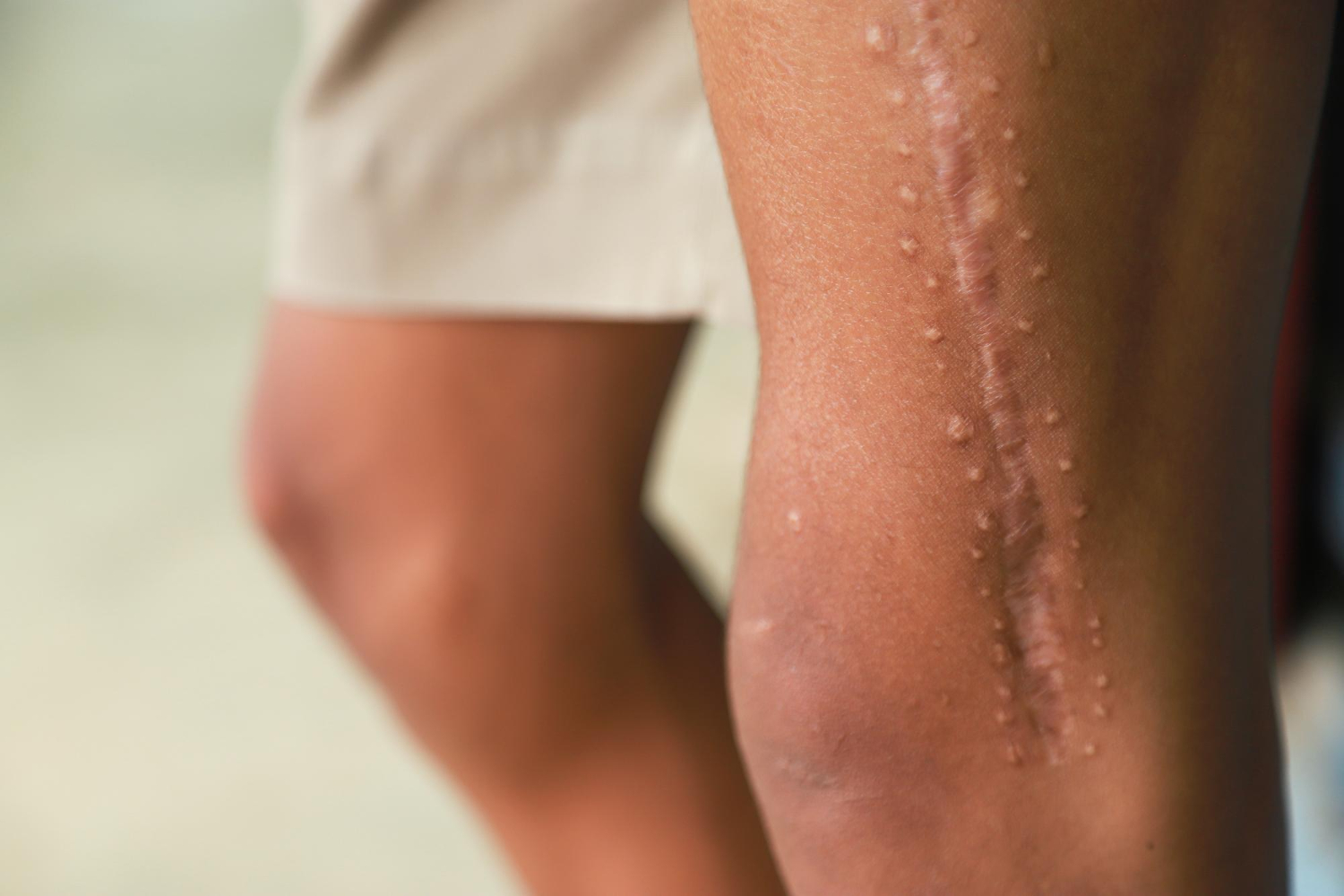Standard microneedling for collagen stimulation and scar improvement