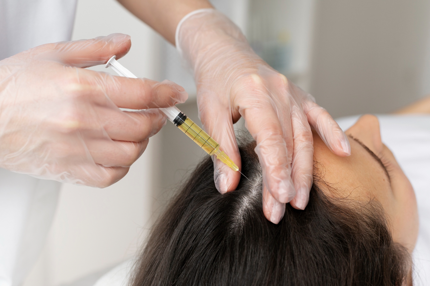 Microneedling for hair regrowth (scalp microneedling)