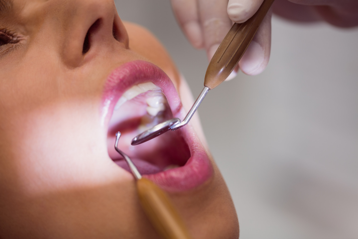 Wisdom tooth removal