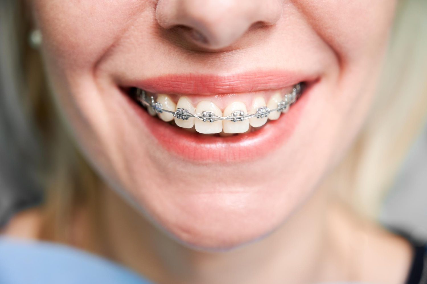 Traditional metal braces
