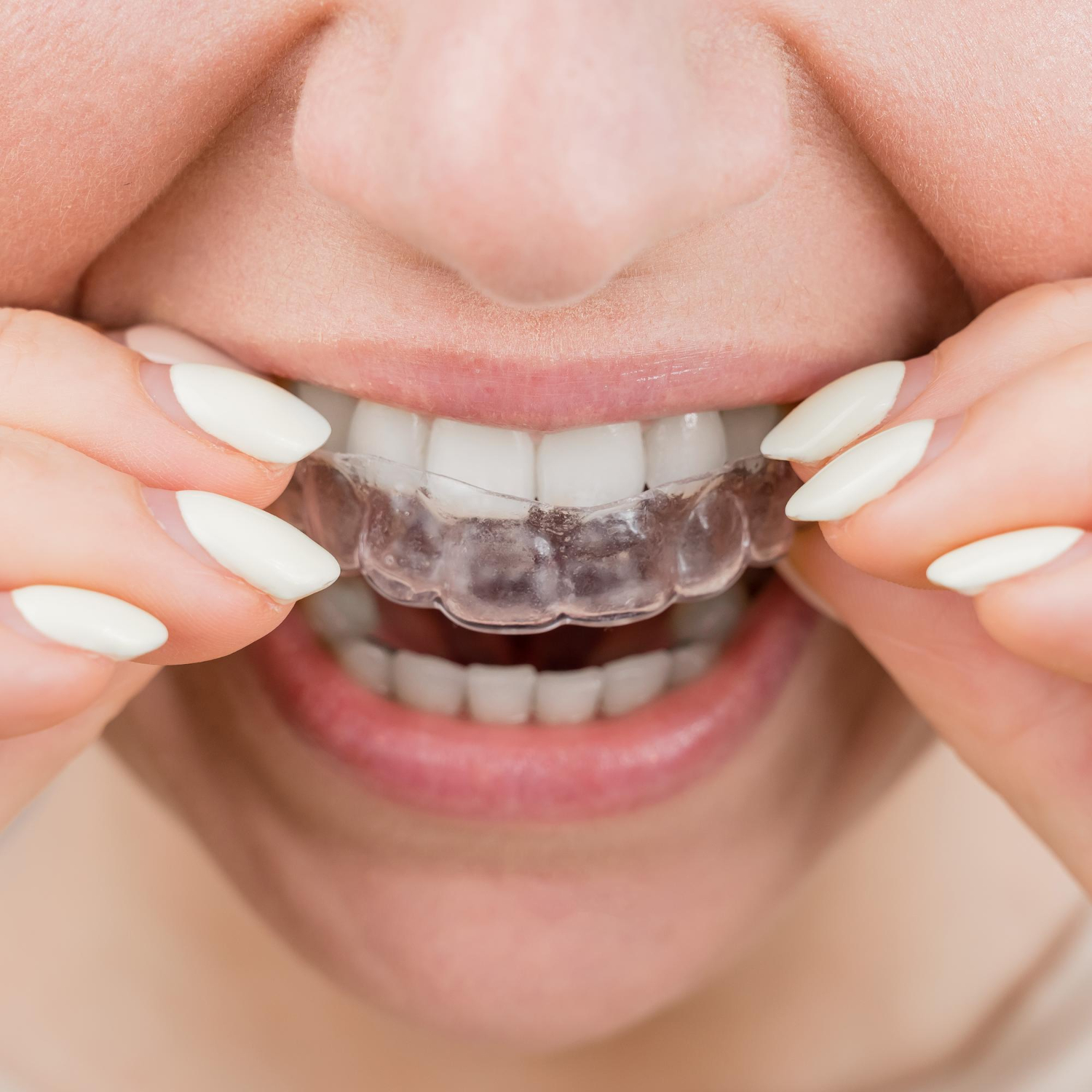 Clear aligner orthodontic treatments