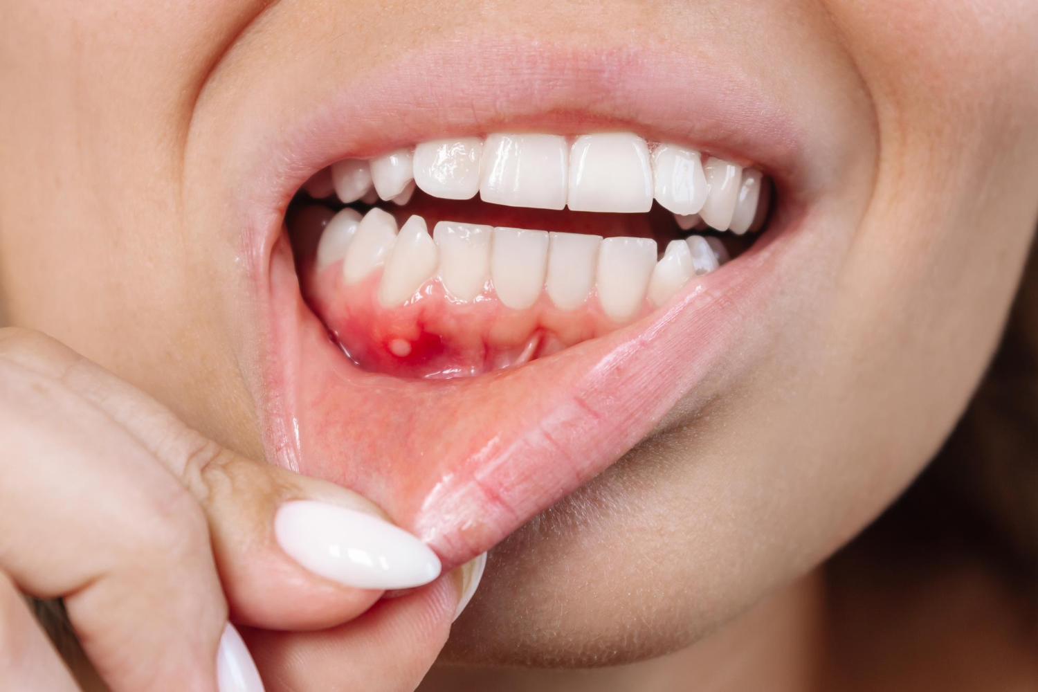 Gum infection management