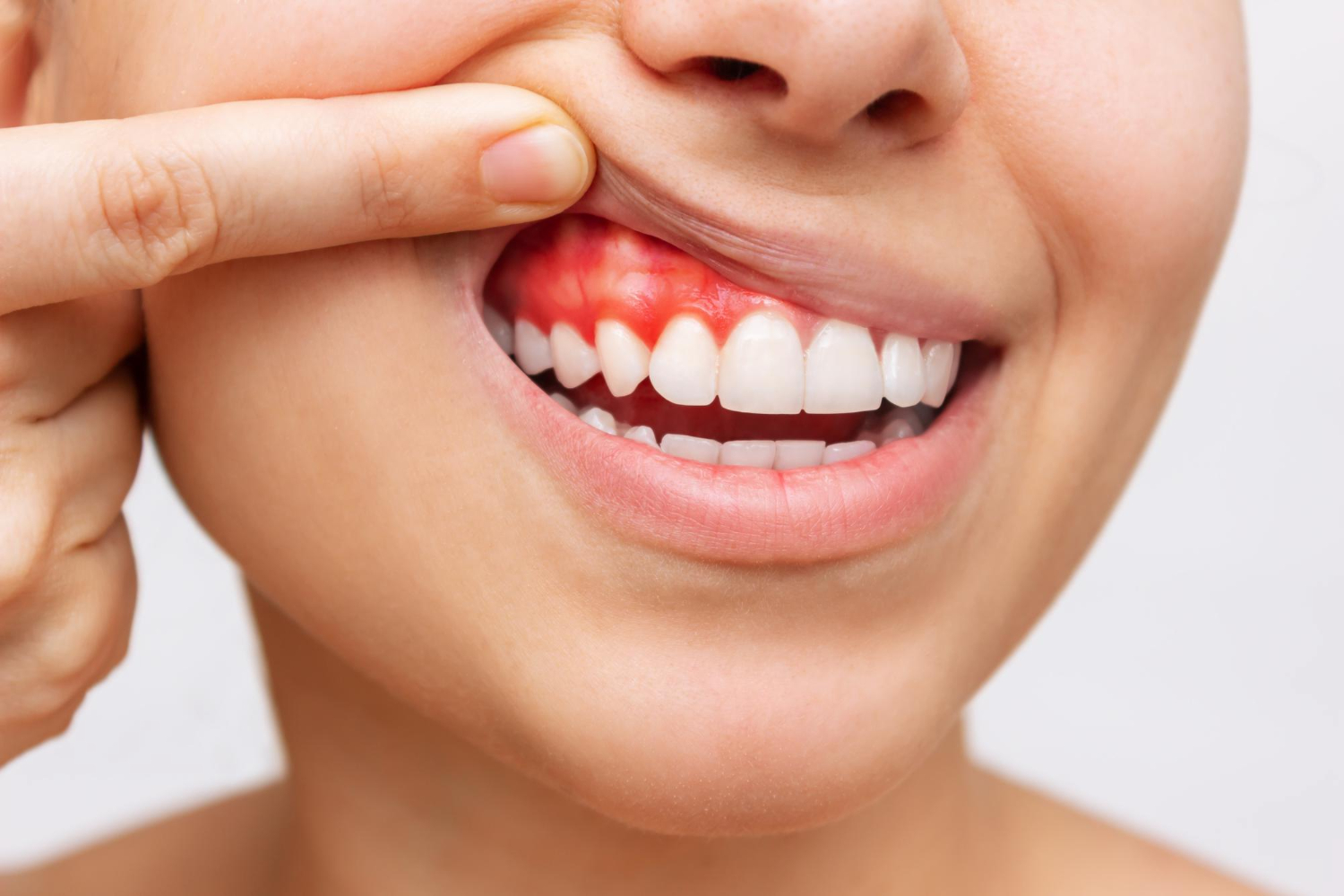Treatment of gum disease (gingivitis and periodontitis)