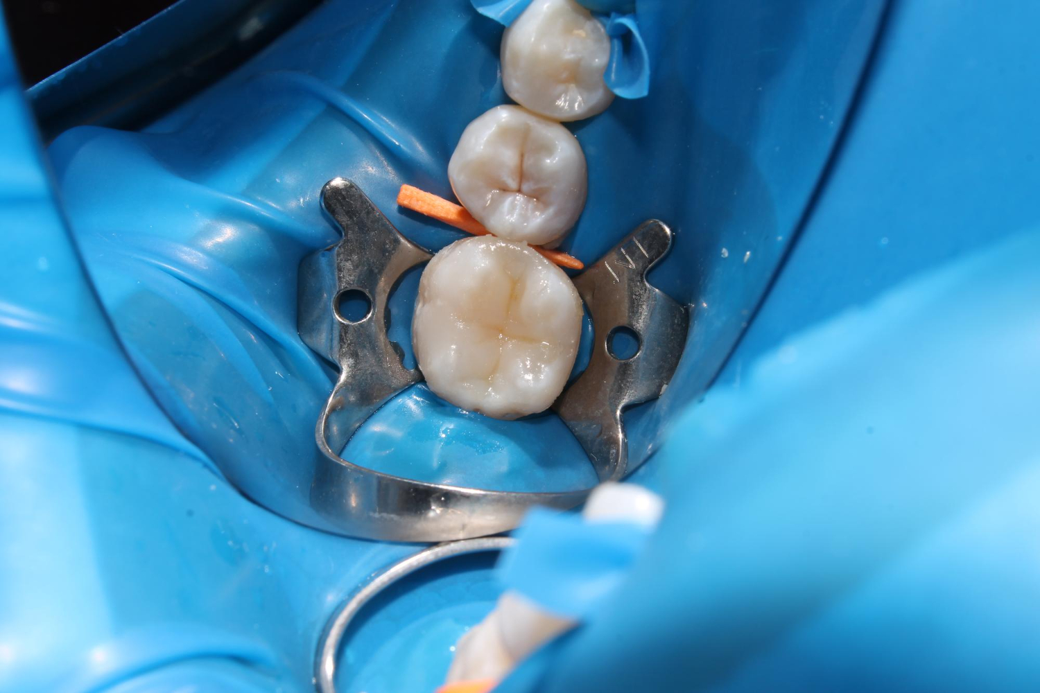 Dental fillings (composite and aesthetic restorations)