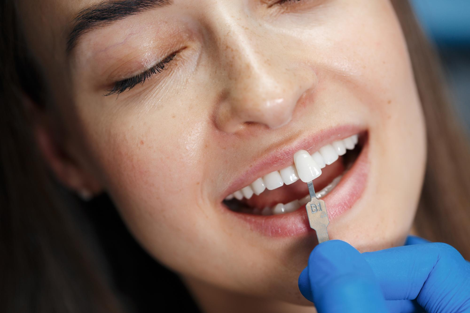 Dental crowns (ceramic, zirconia, porcelain-fused)